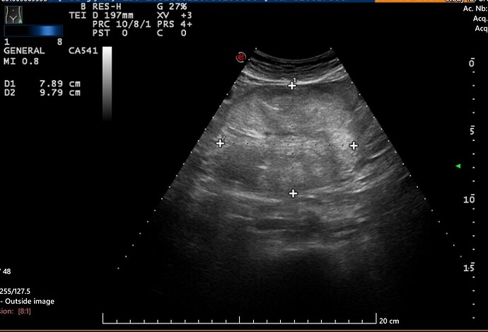 ultrasound mass
